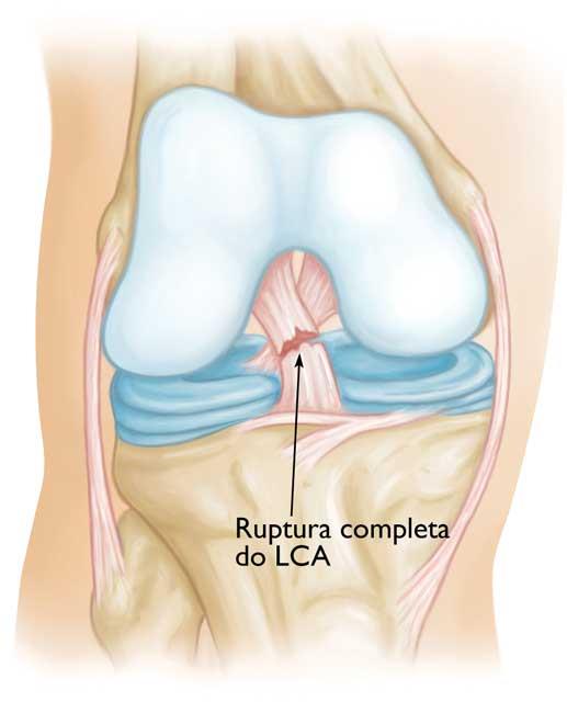 Confira alguns cuidados essenciais no pós-operatório do ligamento